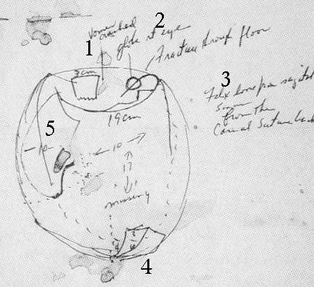 kennedy autopsy pictures. One of Boswell#39;s autopsy